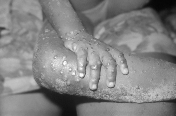 Monkeypox-like lesions on the arm of a girl