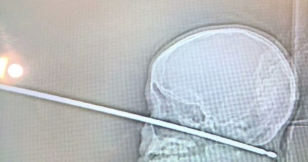 X-ray of metal skewer through head