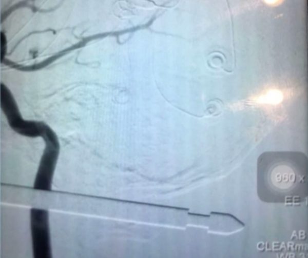 An X-ray shows the tip of the metal skewer