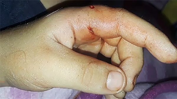 The rabid raccoon bit Chandler’s hand