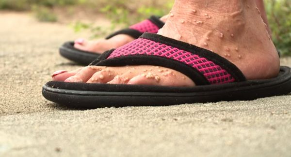 Foot showing fire ant bites