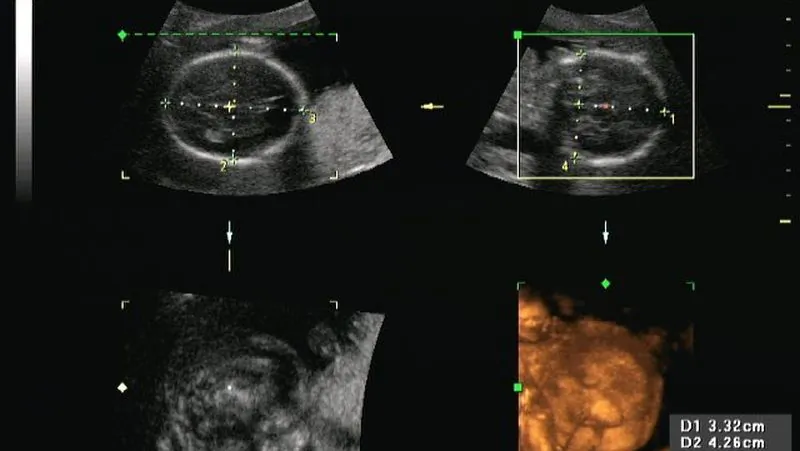 The Ohio House of Representatives has passed an abortion bill that would ban abortions after the first fetal heartbeat is detected, according to The Associated Press. (Terry J. DuBose, M.S., RDMS via Creative Commons Attribution-ShareAlike 3.0 License.)