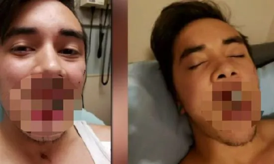 Mom Warns Against Vape Pen After One Explodes, Leaving Son With Broken Jaw
