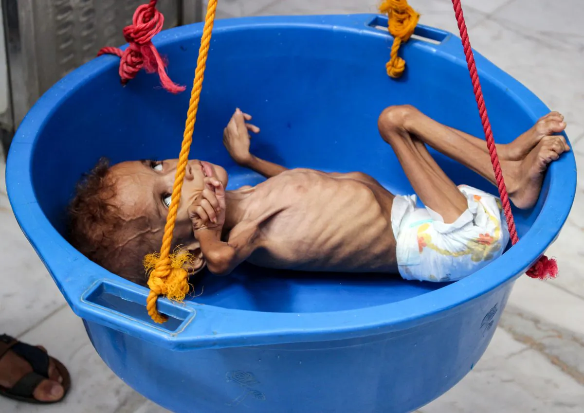A two-year-old Yemeni boy suffering from malnutrition has his weight measured at a hospital in the northern district of Abs in the northwestern Hajjah province on Sept. 19, 2018. (ESSA AHMED/AFP/Getty Images)