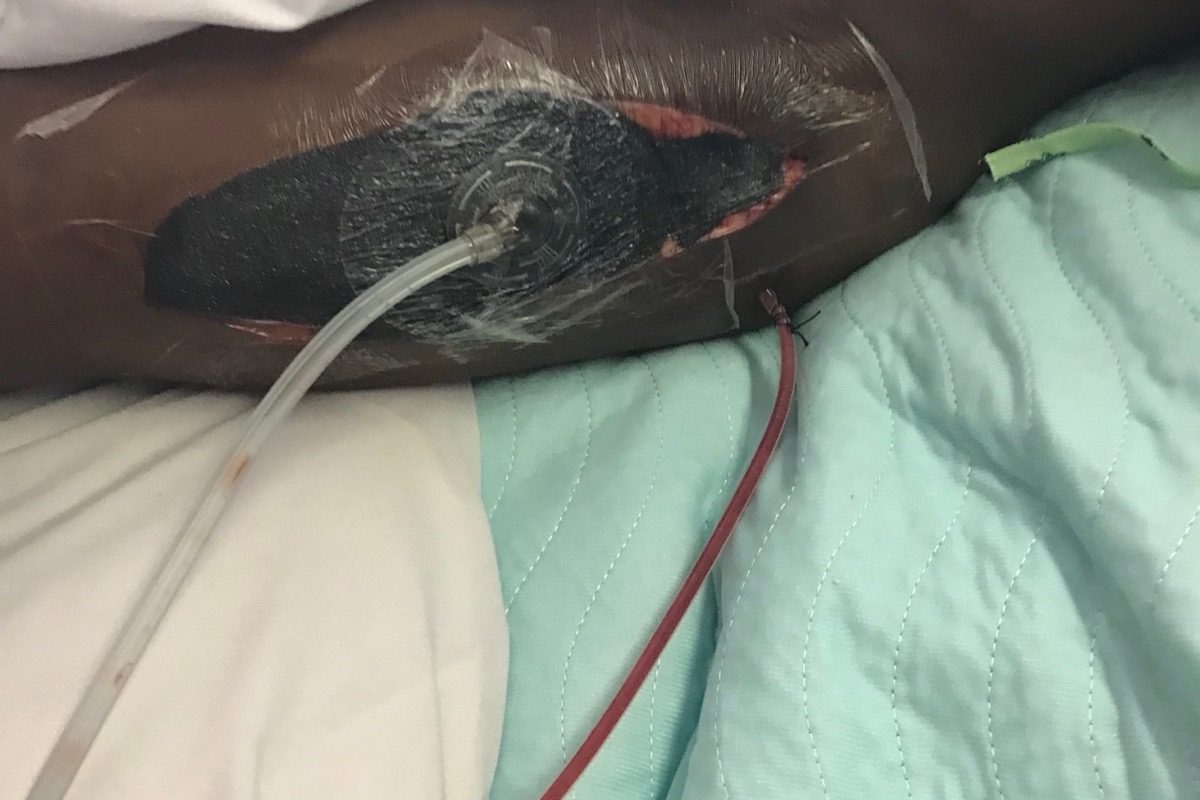 flesh eating bactera in leg