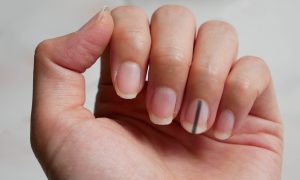 Stripe Under Fingernails Could Be Sign of Cancer, Doctor Warns
