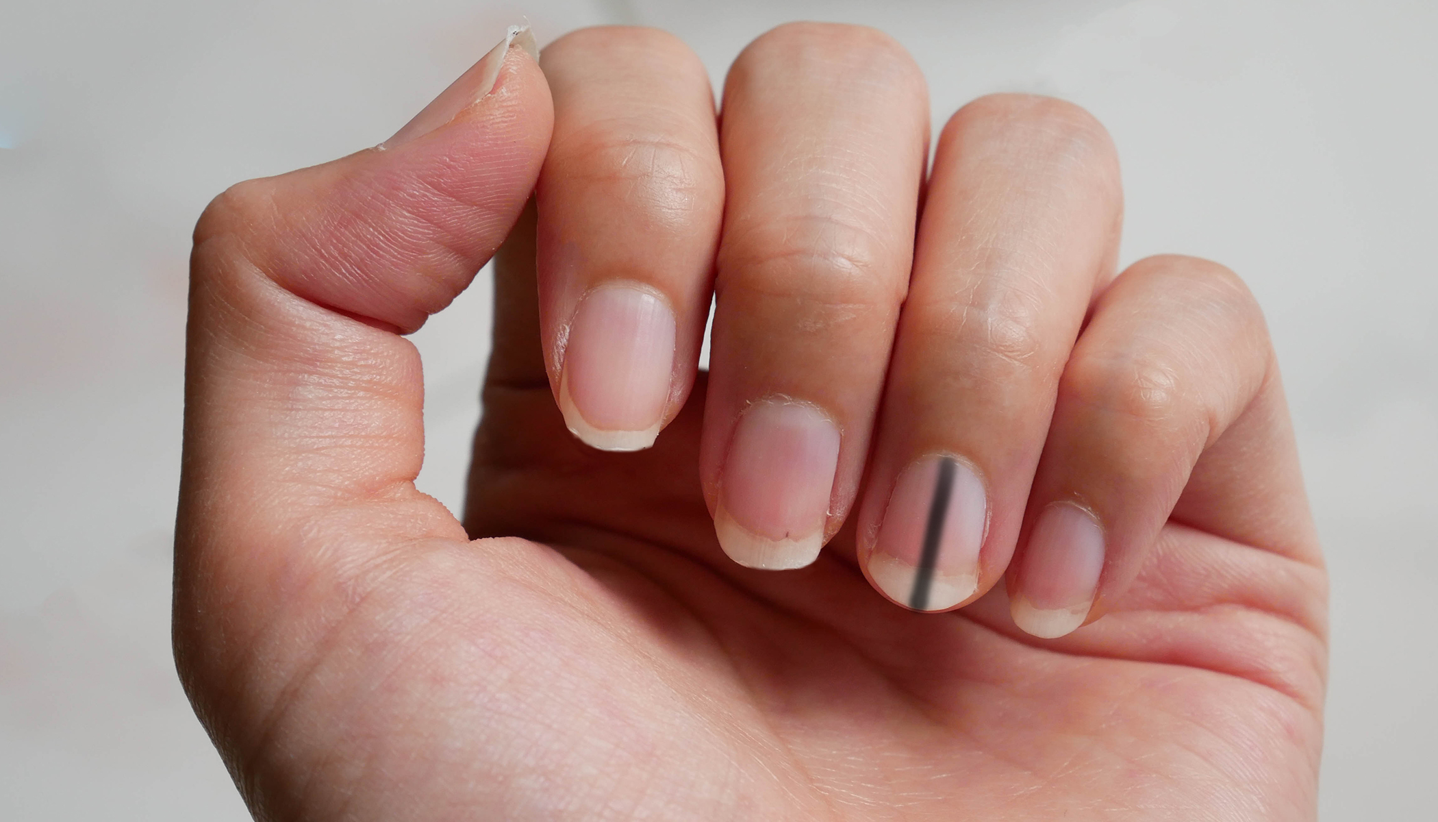 Stripe Under Fingernails Could Be Sign of Cancer, Doctor Warns