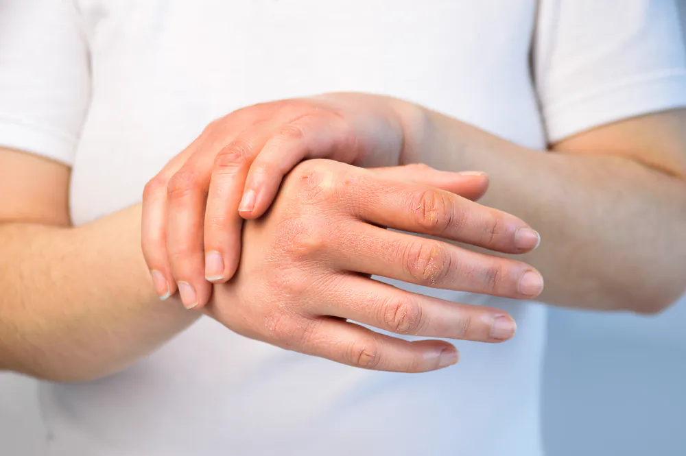 If your hands are consistently dry and you’re experiencing cold or numb extremities, brittle nails, or fatigue, consider ways to boost circulation.(cunaplus/Shutterstock)