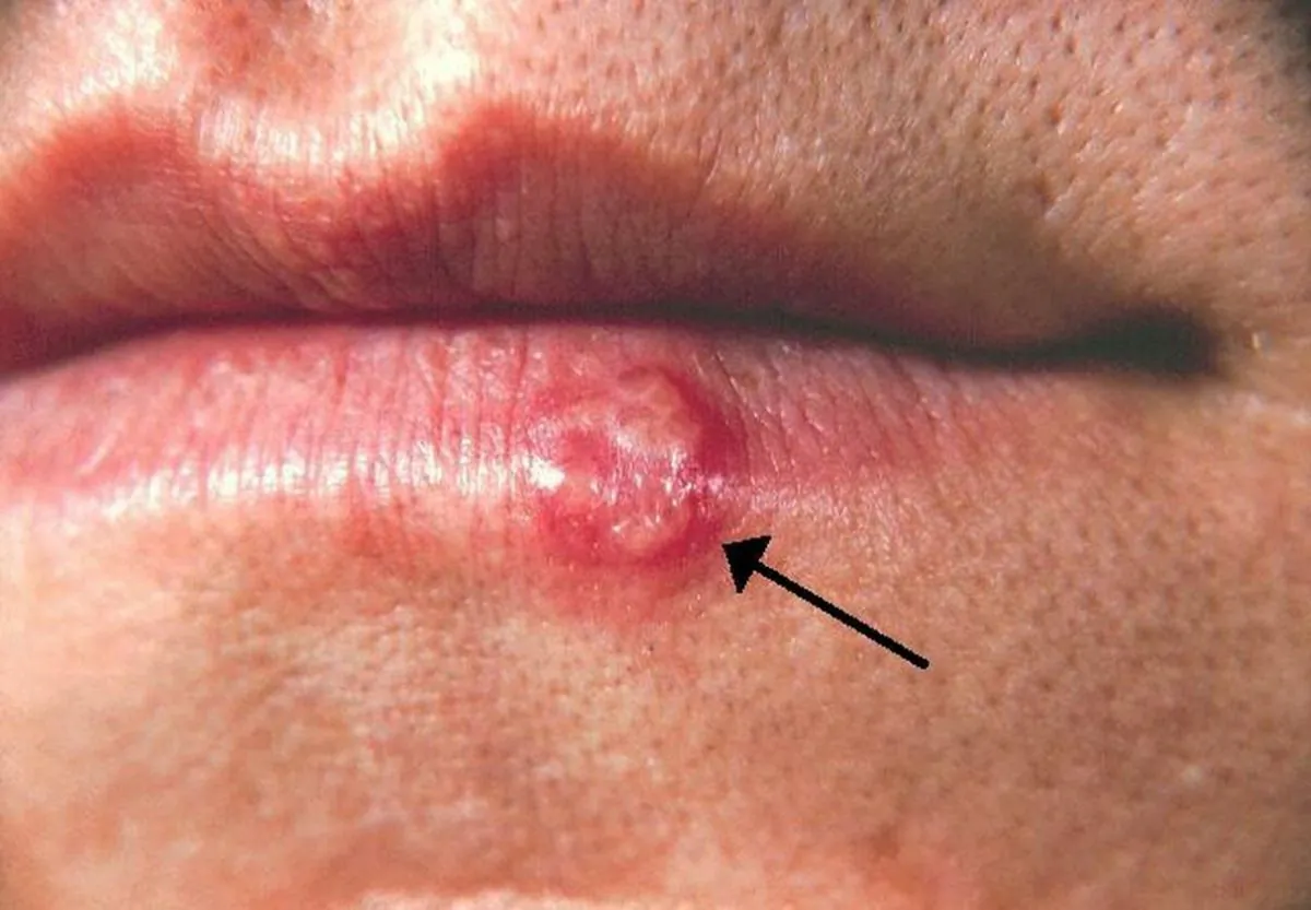An undated photo of a cold sore. (Centers for Disease Control and Prevention)