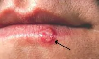 Baby Boy Hospitalized With Herpes Eye Infection After Being Kissed