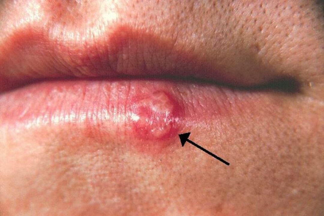 A photo of a cold sore. (Centers for Disease Control and Prevention)