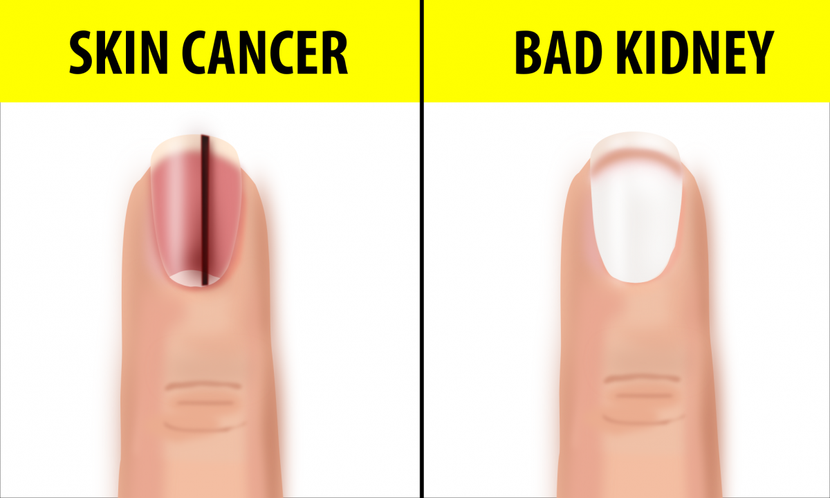 10 Fingernail Symptoms That Can Help Detect Health Conditions If You See Black Lines Go See A Doctor