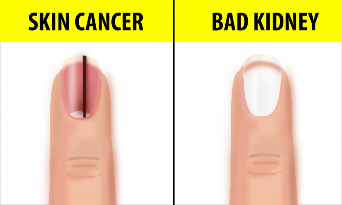 10 Fingernail Symptoms That Can Help Detect Health ...