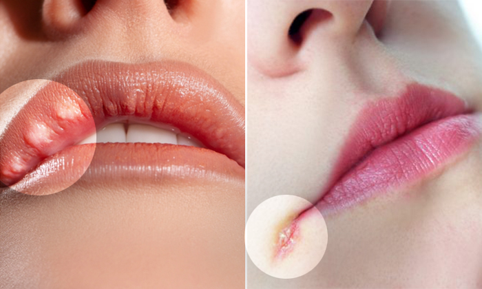 10 Things Your Lips Say About Your Health Tingling Lips May Signify A Stroke Is Coming