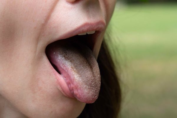 Hairy tongue 