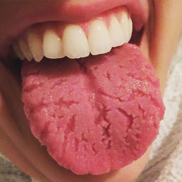 Fissured tongue 