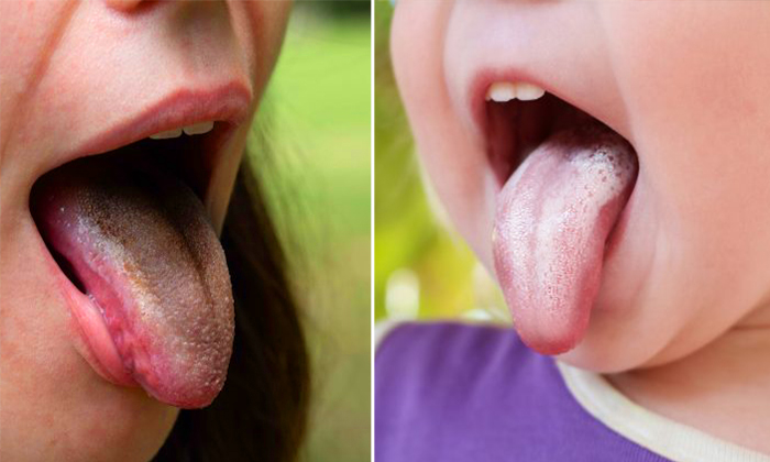 13 Things Your Tongue Says About Your Health–Bright-Red Tongue Means See a Doctor