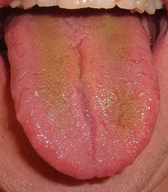 13-things-your-tongue-says-about-your-health-bright-red-tongue-means-see-a-doctor