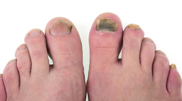Fungus on the big toe
