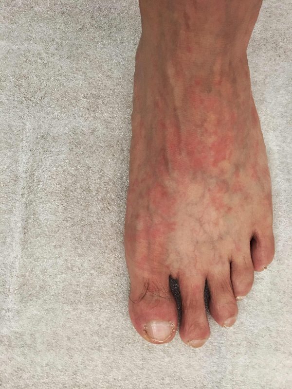 Can Lupus Cause Foot Pain