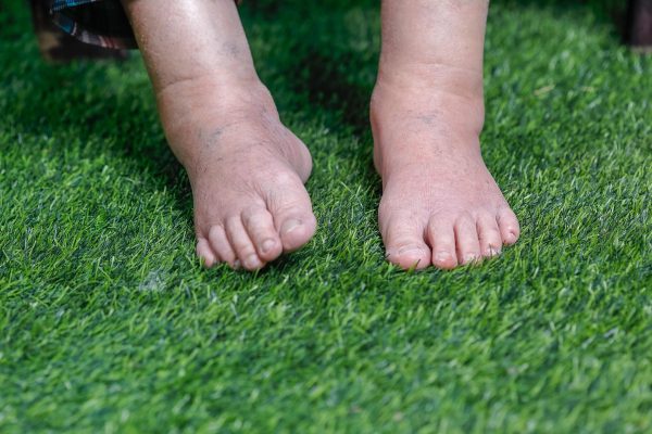 Swollen feet