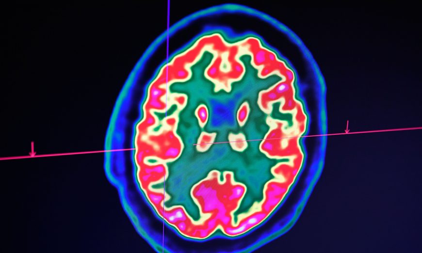 In this file image, a picture of a human brain taken by a positron emission tomography scanner, also called PET scan, is seen on a screen at the Regional and University Hospital Center of Brest in western France on Jan. 9, 2019. (Fred Tanneau/AFP/Getty Images)