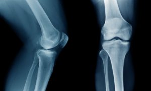 4 Warning Signs of Degenerative Arthritis and 6 Rehabilitative Exercises