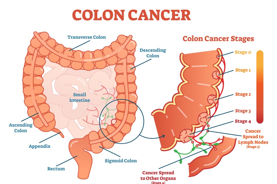 Colon cancer (VectorMine/Shutterstock)