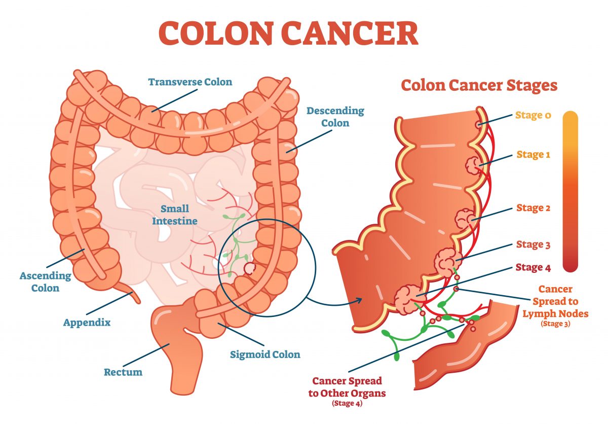 Colon cancer (VectorMine/Shutterstock)