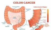 Vegetarians Can Also Get Colon Cancer? 6 Tips to Keep Your Vegetarian Diet Healthy