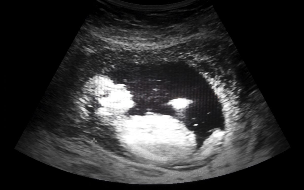A file photo of an ultrasound film of a 13-week fetus. (Kornn Photo/iStock)