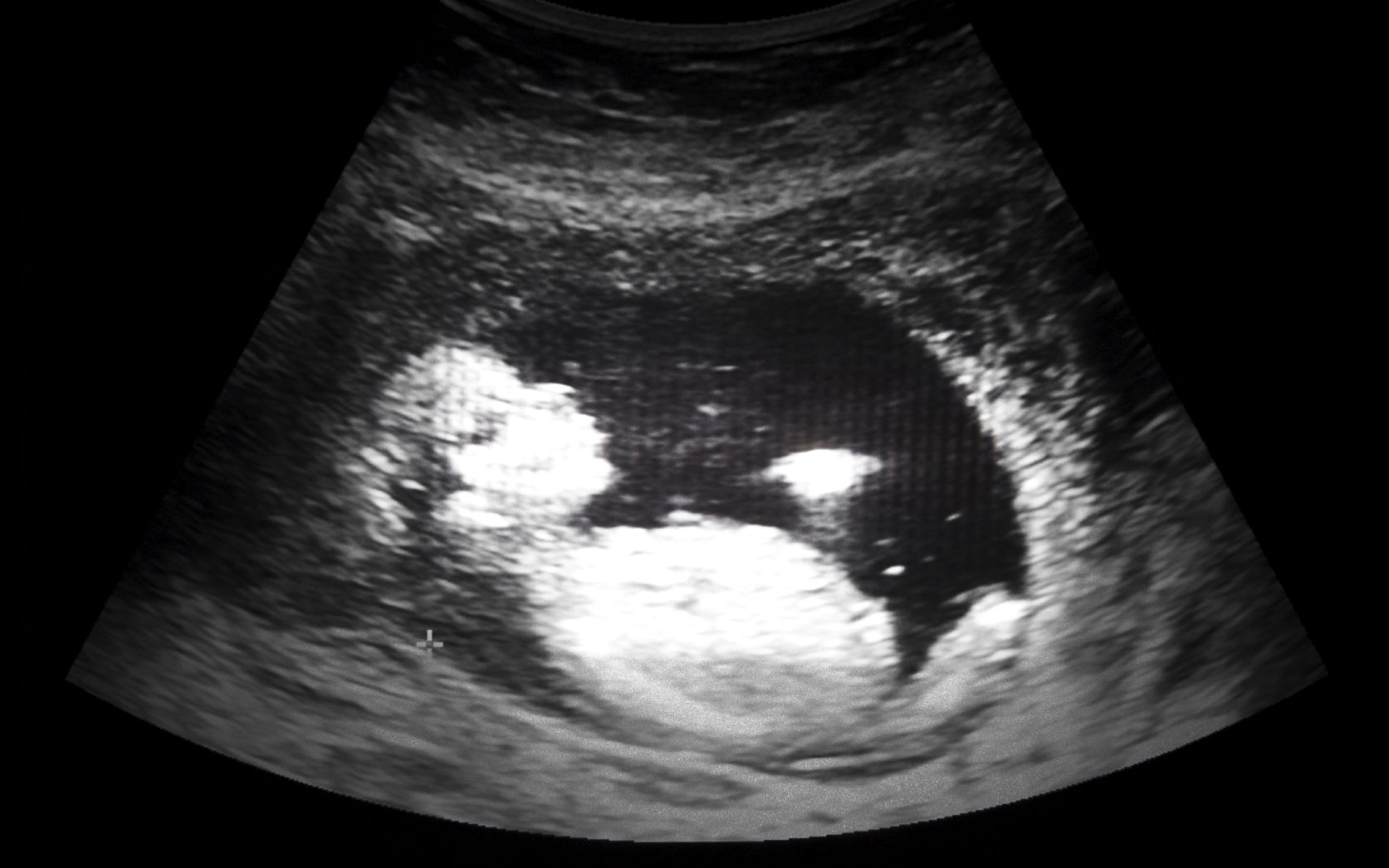 Плод 13 недель беременности фото как выглядит