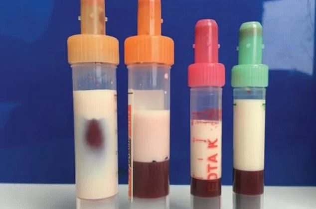 Samples of the man's blood about two hours after they were drawn, with the white colored substance being the fat. (Annals of Internal Medicine/American College of Physicians)