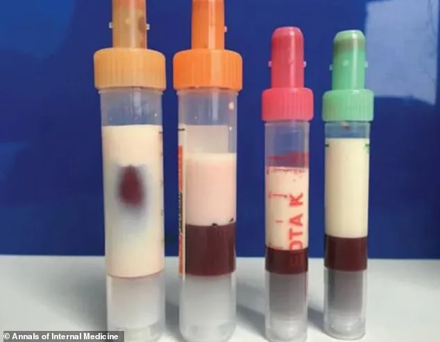 Samples of the man's blood about two hours after they were drawn, with the white colored substance being the fat. (Annals of Internal Medicine/American College of Physicians)