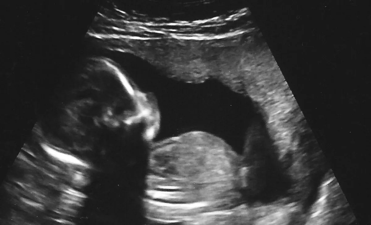 An ultrasound image of a baby in the 18th week of pregnancy. ("Baby McBride Ultrasound 17 Weeks 6 Days (3)" by Nogwater/Flickr[CC BY-SA-2.0 (ept.ms/2utDIe9)])