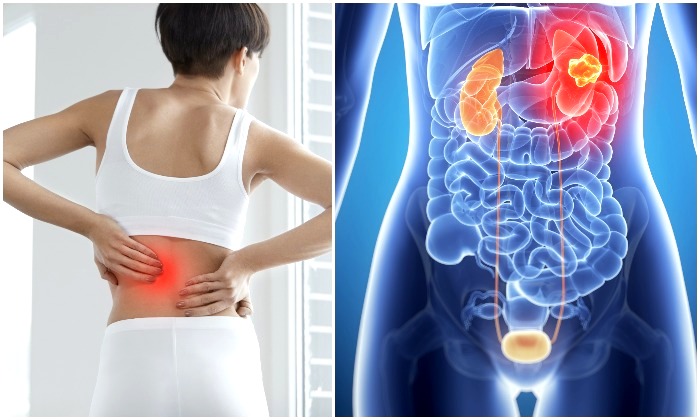 9 Warning Signs of Kidney Cancer Not To Ignore–Do You Feel ...