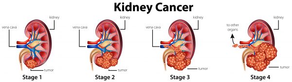 Four stages of kidney cancer