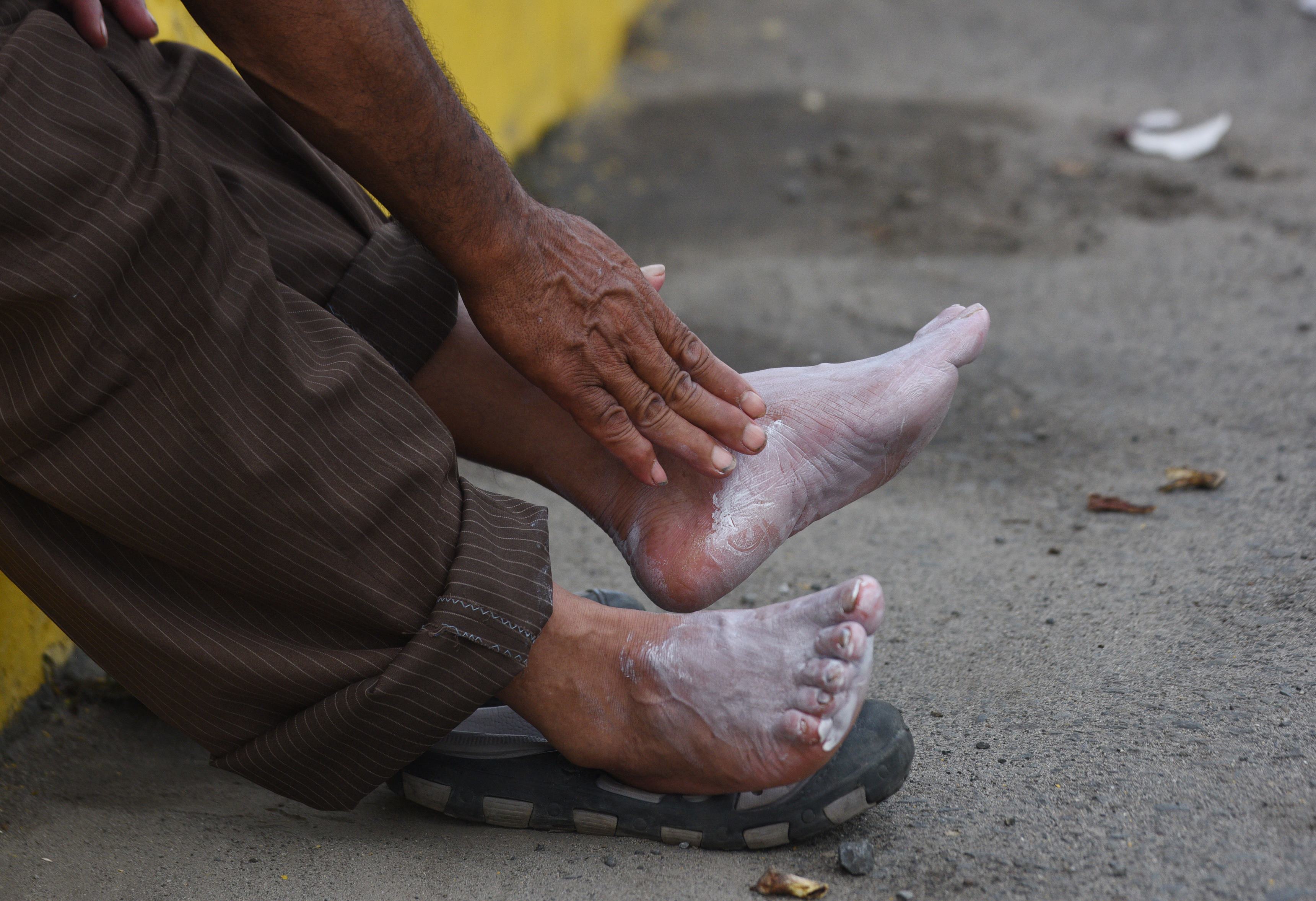Illegals Show Up At Border With Rotting Feet Disease Fevers Illegals Show Up At Border With Rotting Feet Disease Fevers
