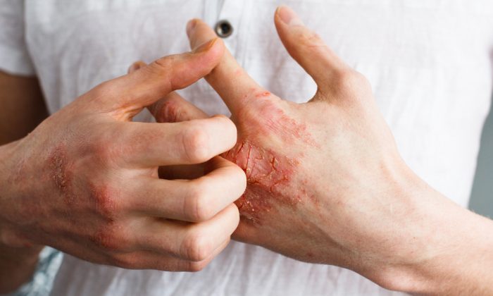 Eczema (Ternavskaia Olga Alibec/Shutterstock)
