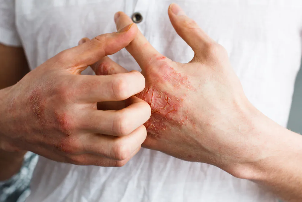Eczema (Ternavskaia Olga Alibec/Shutterstock)