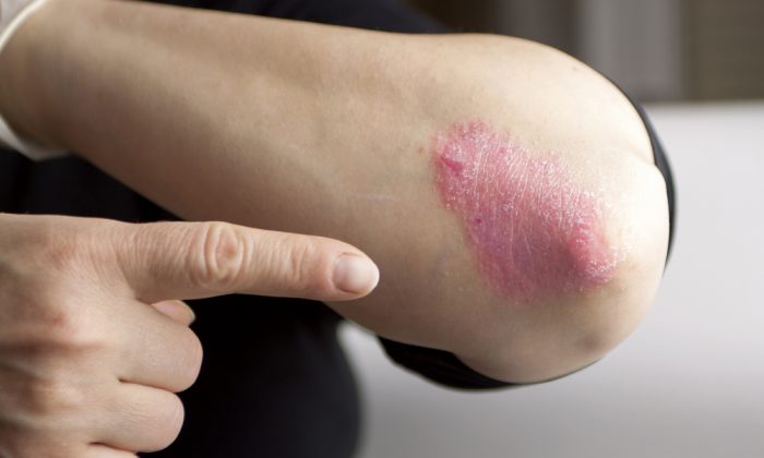 Poor Stress Coping Skills Tied to Increased Risk of Psoriasis: Study