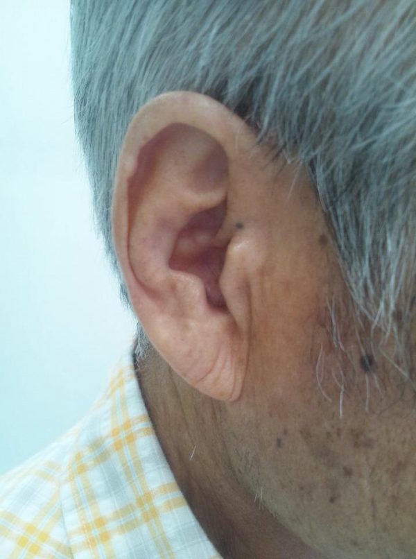 8-things-your-ears-reveal-about-your-health-what-do-earlobe-creases