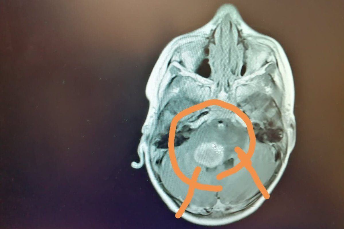 Jack's CT scan