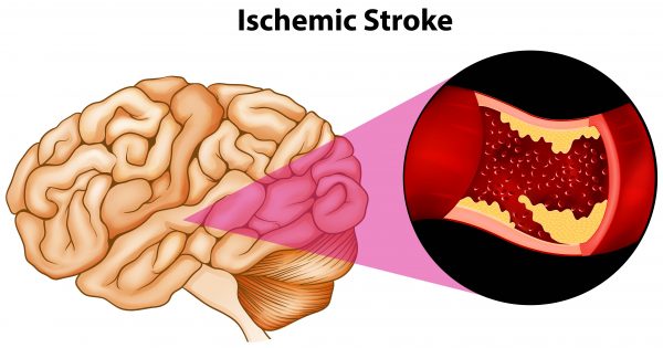 Ischemic stroke