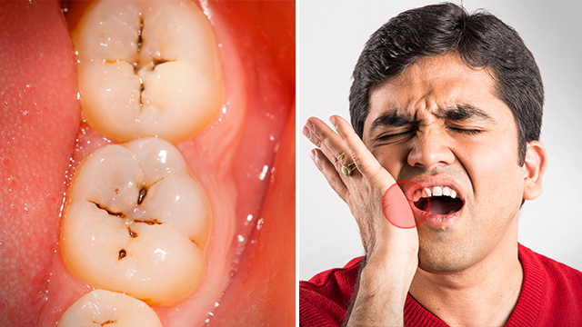 7 Keys to Avoiding Tooth Decay, Dentists Reveal–It’s Not as Simple as Just Brushing