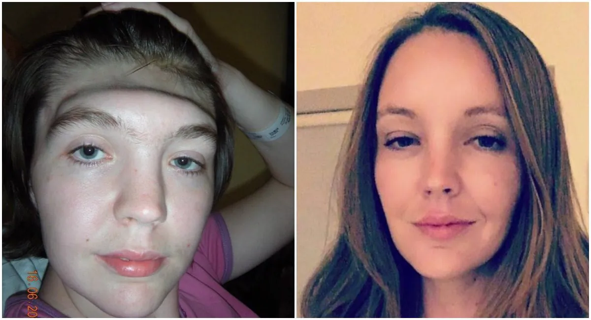 Grainne Kealy pictured in 2009 (L) just before her ceramic forehead was fitted, which can be seen in a later picture from 2016. (Grainne Kealy)