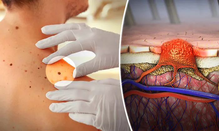 Skin Microbiopsy Device in Development Creates New Possibilities in Diagnosis