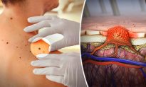 7 Signs That May Indicate Melanoma: The Most Serious Type of Skin Cancer in the World