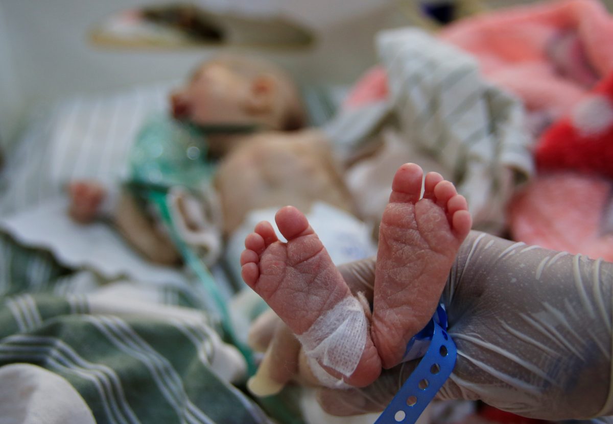 A child of Islamic State terrorist, who suffers from malnourishment, is seen at a hospital in Hasaka