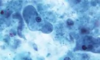 E. Coli Outbreak Linked to Packaged Salads Sickens People in 6 States